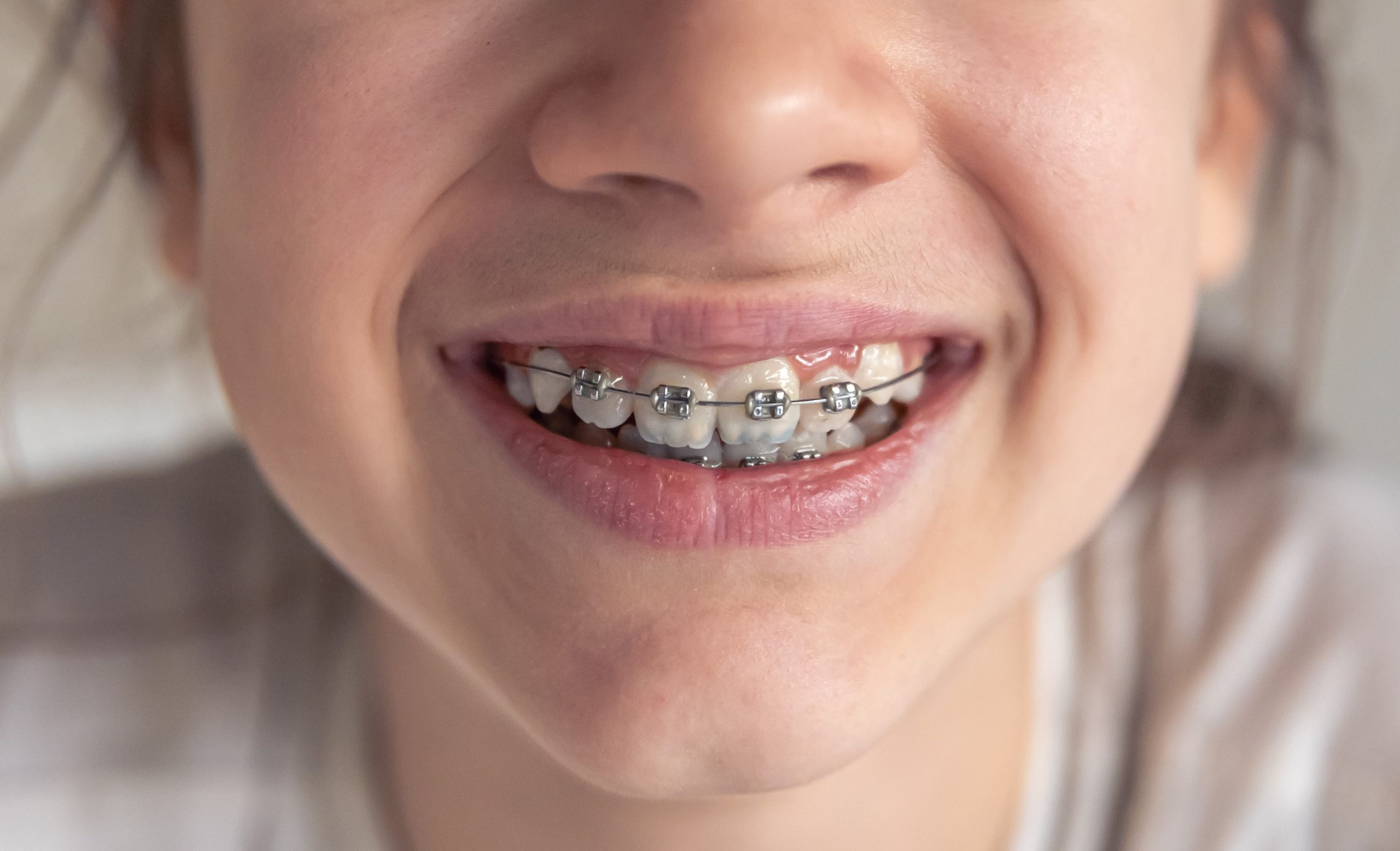 niña con ortoodncia sonriendo